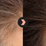 Folligen Black Treatment, 50ml.